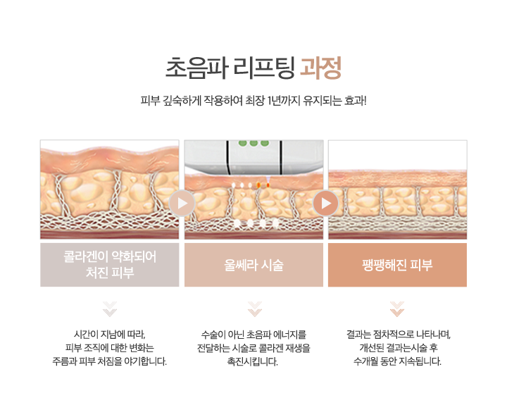 초음파 리프팅 과정