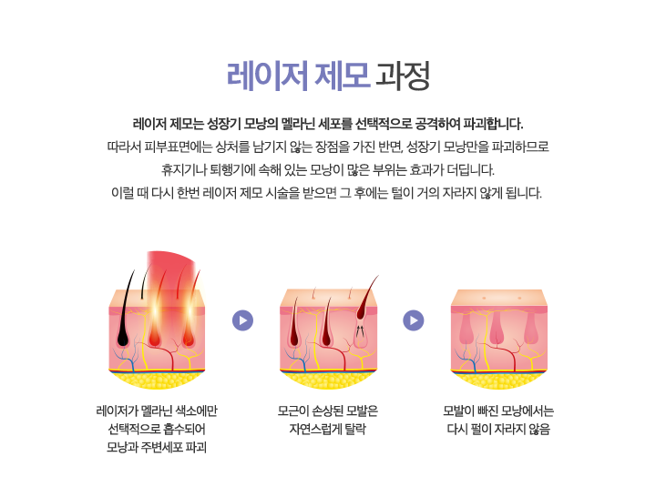 레이저 제모 과정