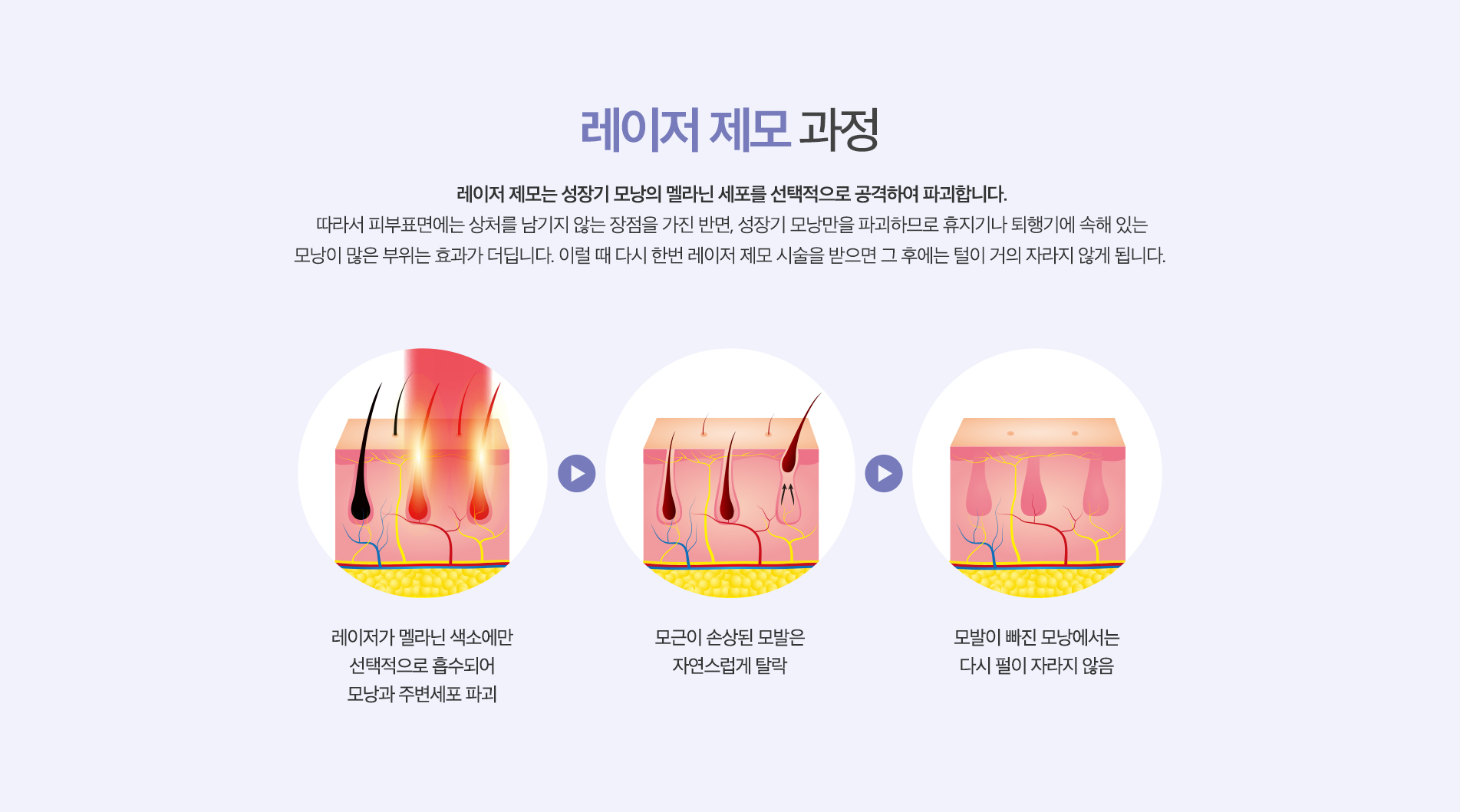 레이저 제모 과정