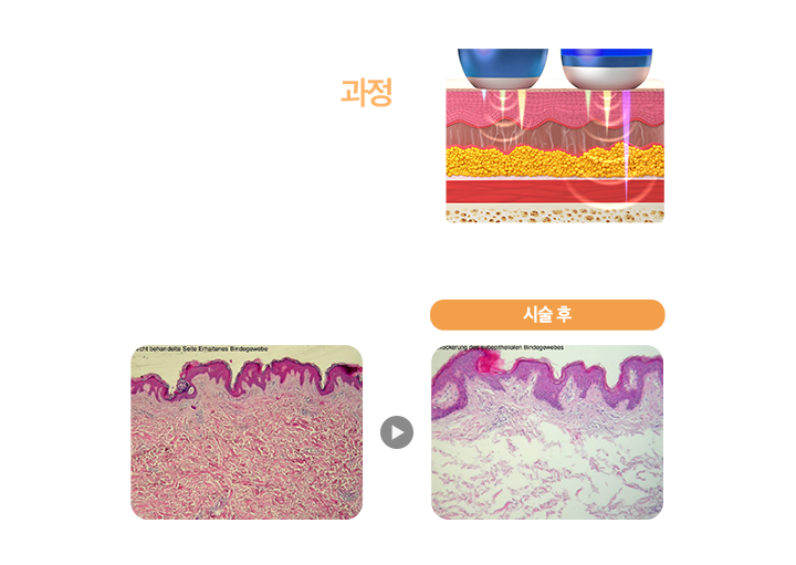 LDM 물방울 리프팅 과정