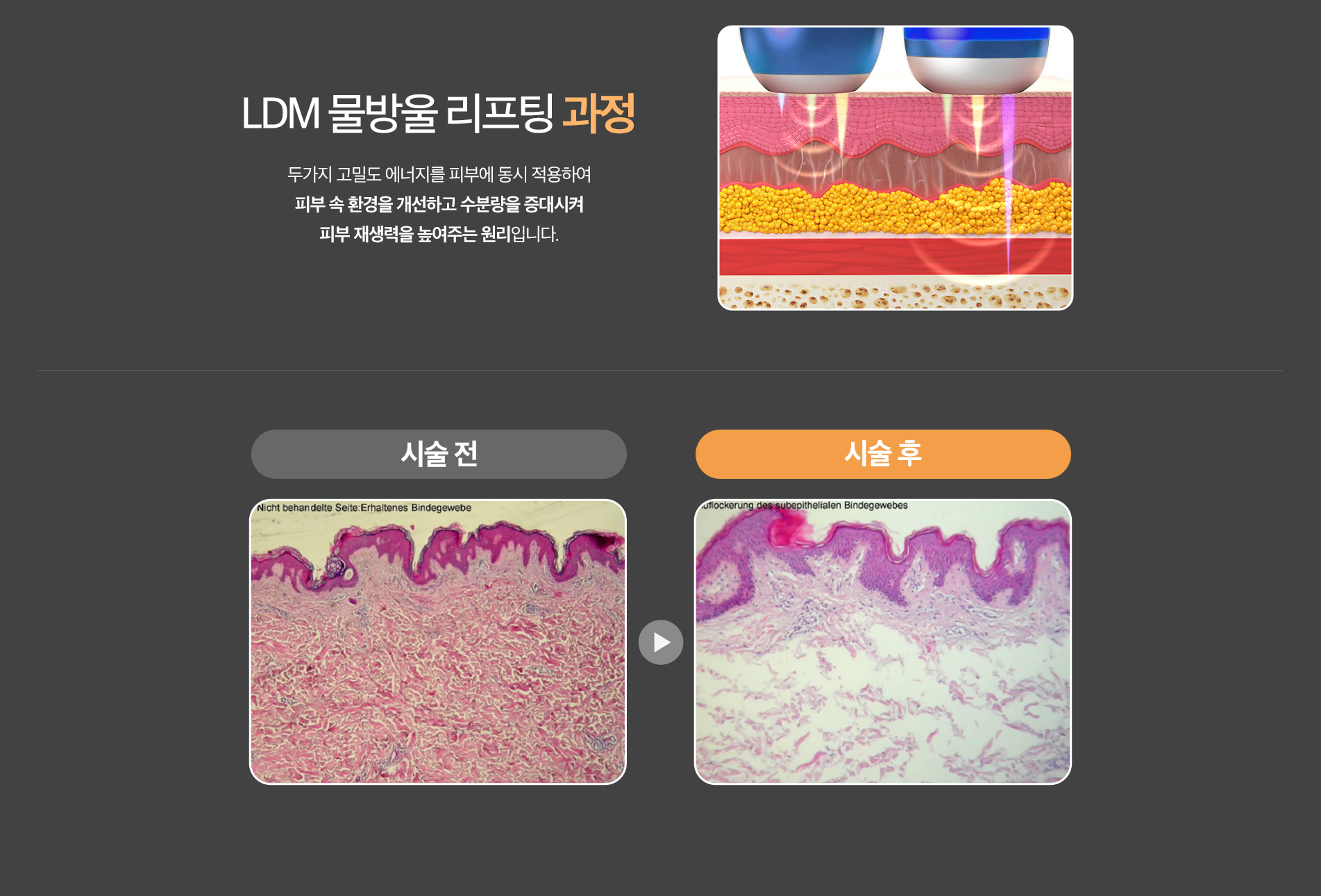 LDM 물방울 리프팅 과정